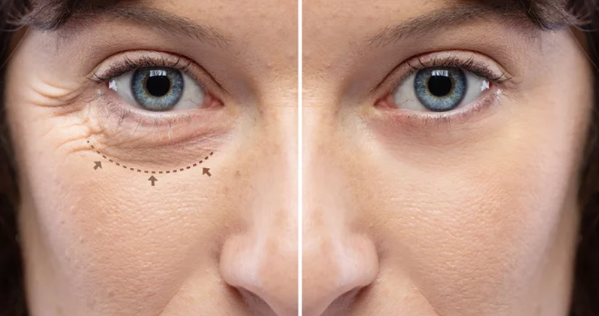 Upper Blepharoplasty Before and After