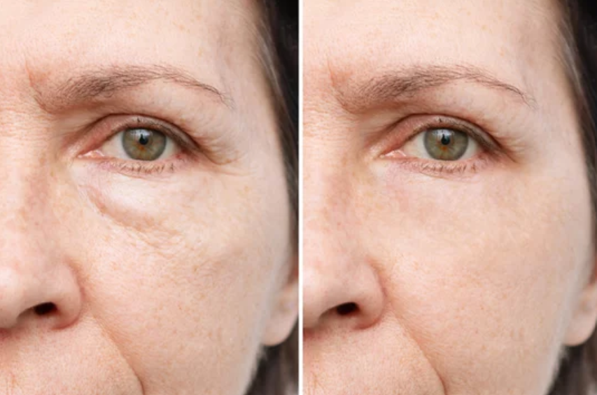 Lower Blepharoplasty Before and After