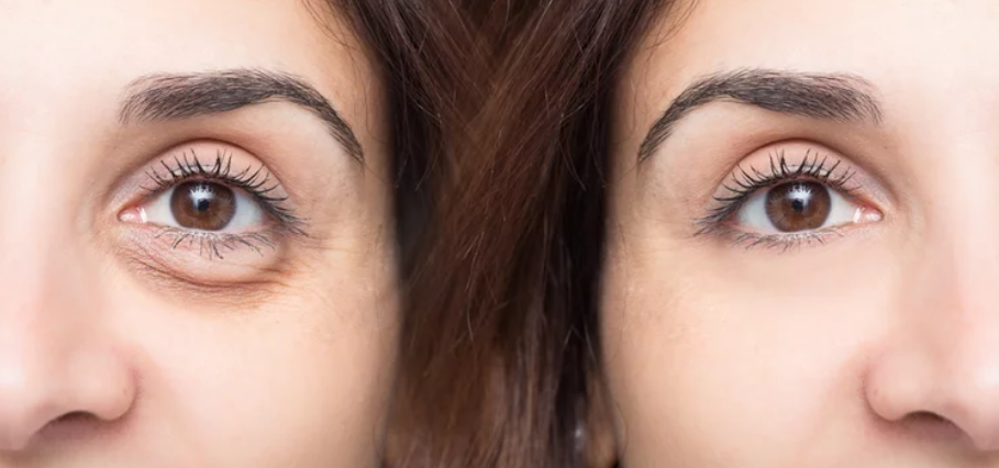 Minor Eyelid Lesion Removal