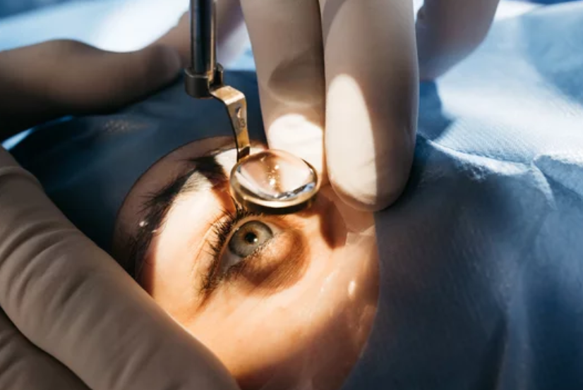 Cataract Surgery